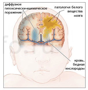 Гипоксически-ишемическое поражение ЦНС