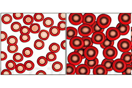 Результат анализа крови при анемии thumbnail