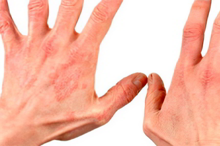 Экзема кожи рук причины и лечение thumbnail