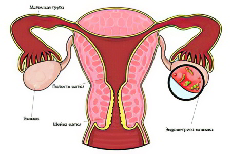 Как вылечить эндометриоз матки яичника