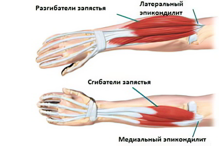 Наружный и внутренний эпикондилит