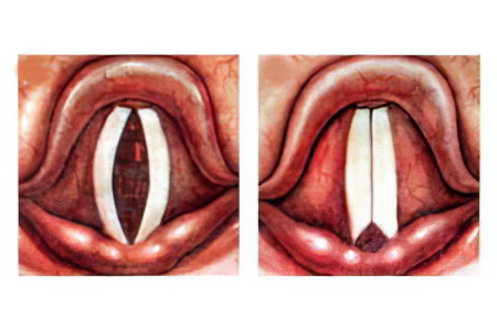 паралич гортани