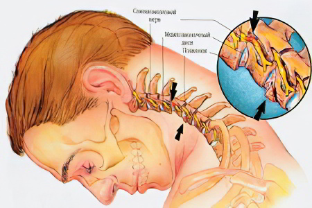 Причины грыжи шейного отдела позвоночника