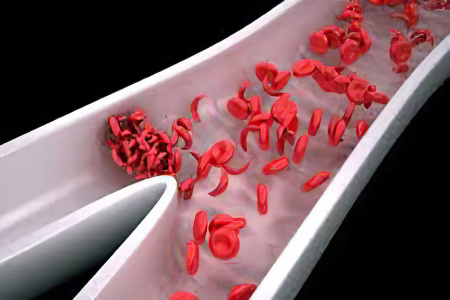 Причиной развития серповидноклеточной анемии является thumbnail
