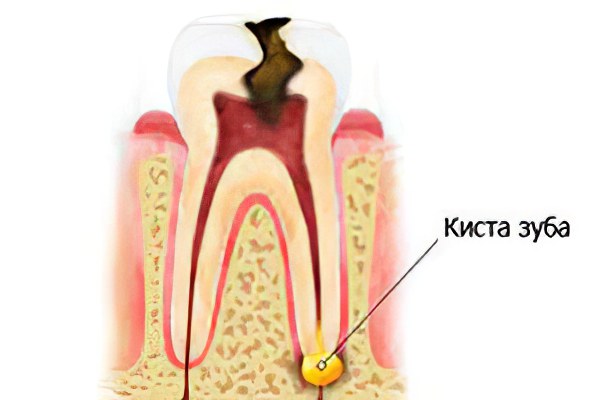 При кисте на корне зуба болит голова thumbnail