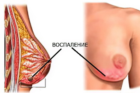 Как вылечить гнойный мастит