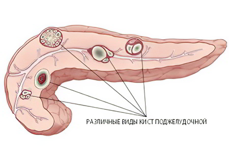 Классификация кист поджелудочной железы