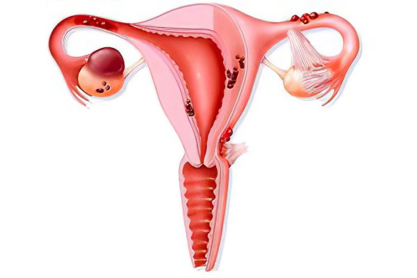 Как можно вылечить эндометриоз яичника