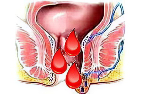 Кровотечение из заднего прохода