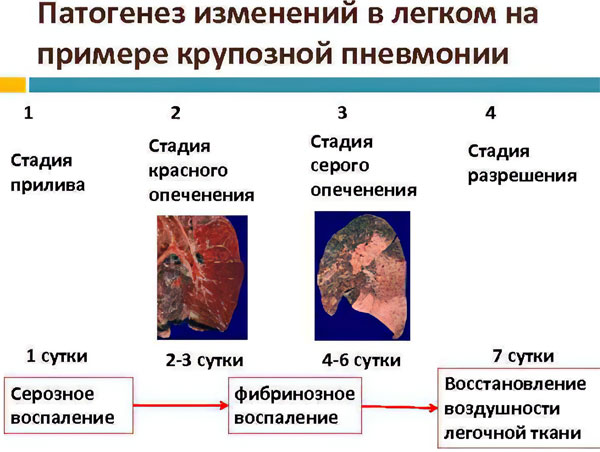 Крупозная пневмония стадии