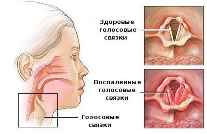 Симптомы ларинготрахеита