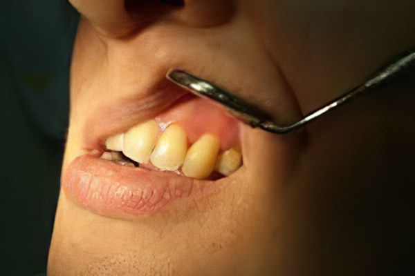 Киста зуба операция отек thumbnail