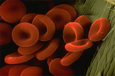Серповидноклеточная анемия кратко основное thumbnail