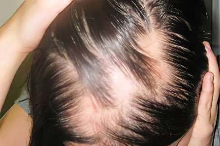 Выпадение волос по бокам у женщин thumbnail