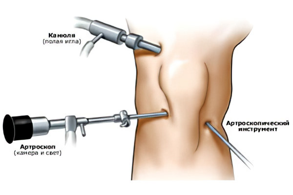 Оперативное лечение при хрусте в колене