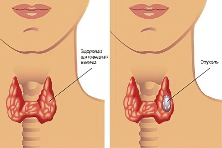Опухоль щитовидной железы