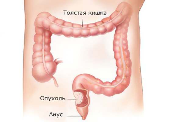 Опухоль толстой кишки