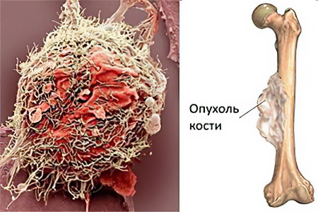 Опухоль костей