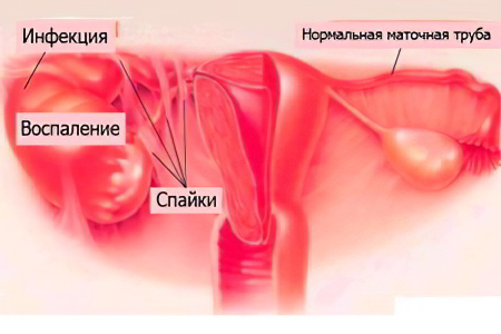 Осложнения спаечного процесса