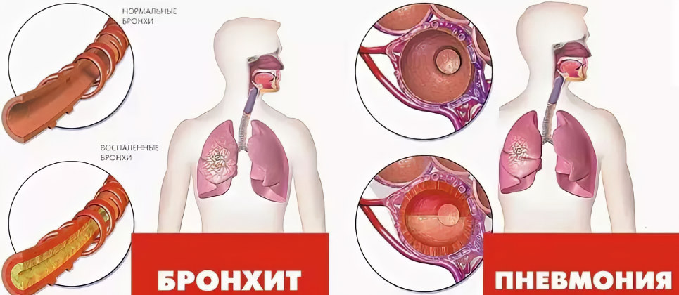 Отличия пневмонии от бронхита