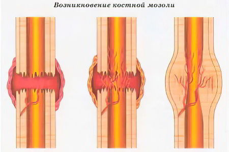 Патогенез