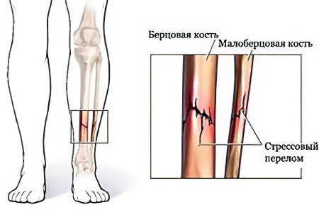 Переломы малой берцовой кости