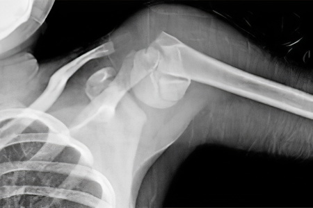 Иммобилизация перелом плечевой кости thumbnail