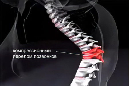 Перелом позвоночника