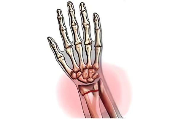 Как закрепить руку при переломе кисти thumbnail