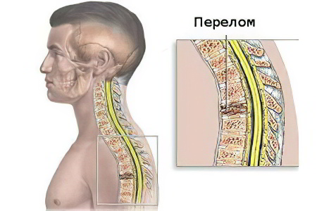 Перелом грудного отдела позвоночника