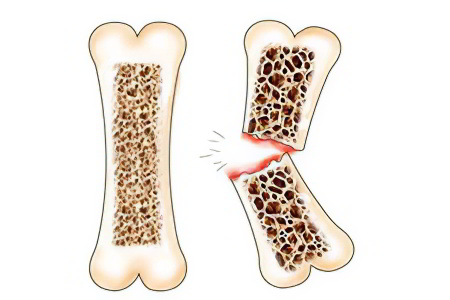 Как лечить переломы костей при остеопорозе thumbnail