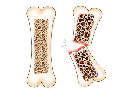 Переломы при остеопорозе