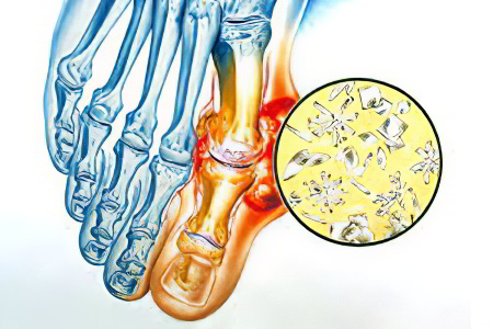 Подагрический артрит