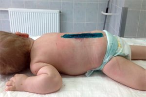 Новорожденный ребенок с грыжей позвоночника thumbnail