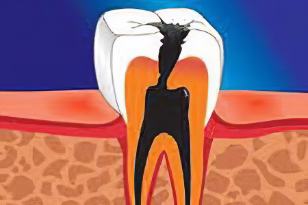 Причины кисты зуба