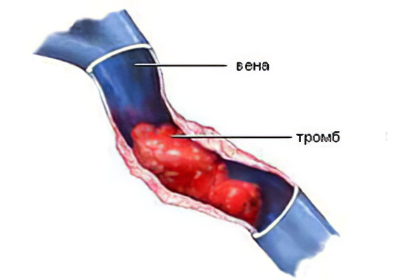 Как вылечить тромбоз подвздошной вены thumbnail