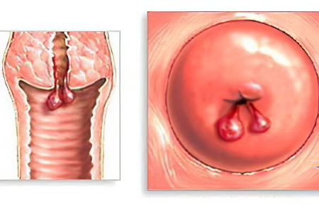 Признаки кисты шейки матки