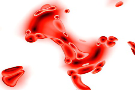 Какие анемии характеризуются выраженной гипохромией эритроцитов thumbnail