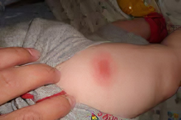 После прививки полиомиелит тошнит ребенка thumbnail