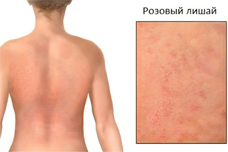 Розовый лишай Розовый лишай