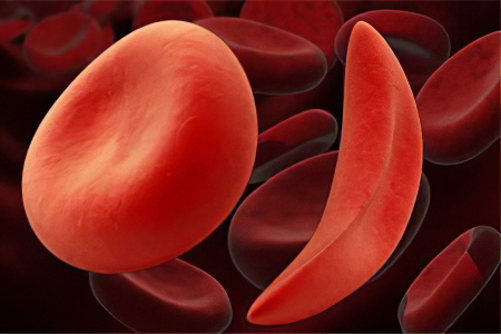 Серповидноклеточная анемия как лечить thumbnail