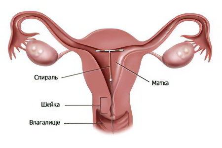 Внутриматочная спираль