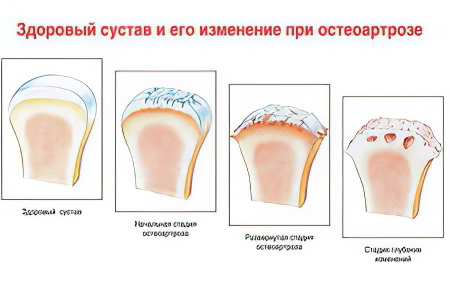 Степени остеоартроза