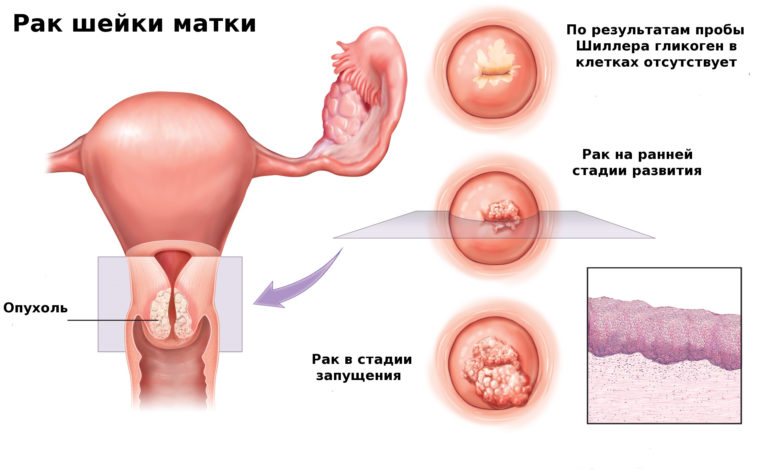 Рак матки или яичников