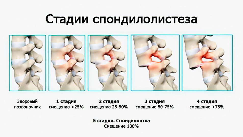 Стадии спондилеза