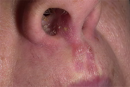 Стафилококк пневмонии в носу анализ расшифровка thumbnail