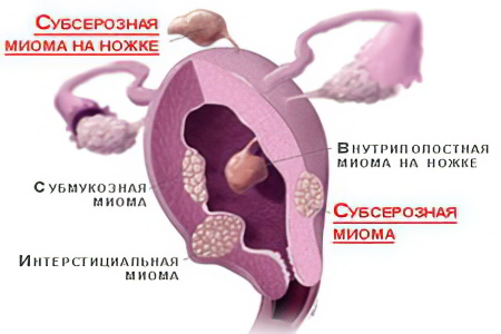 Симптомы субсерозной миомы матки