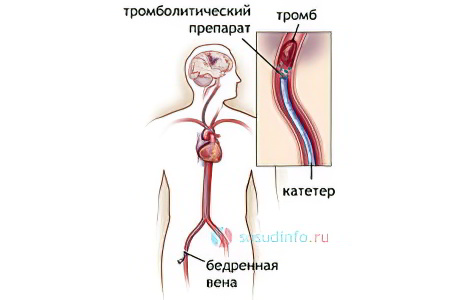 Методы проведения тромболизиса