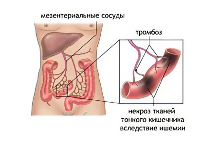 Пути поступления тромбов в брыжейку