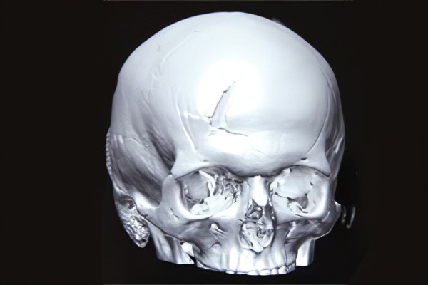 Вдавленный перелом черепа симптомы thumbnail
